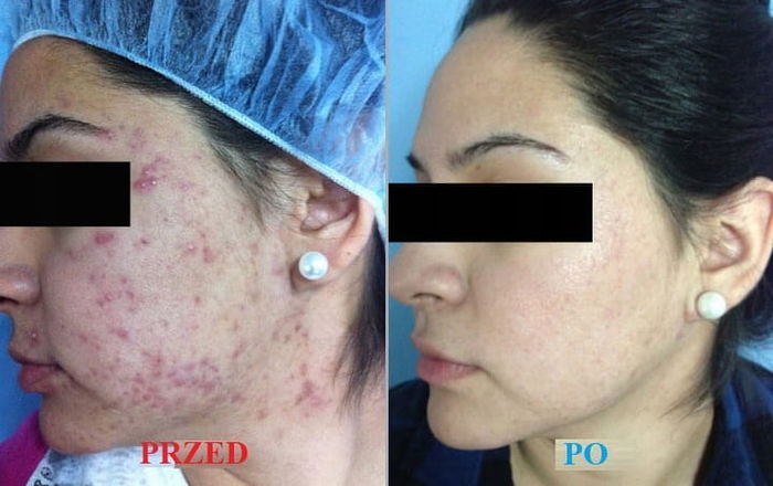 Oczyszczanie Wodorowe 13 Modułów Oxybrazja Peeling